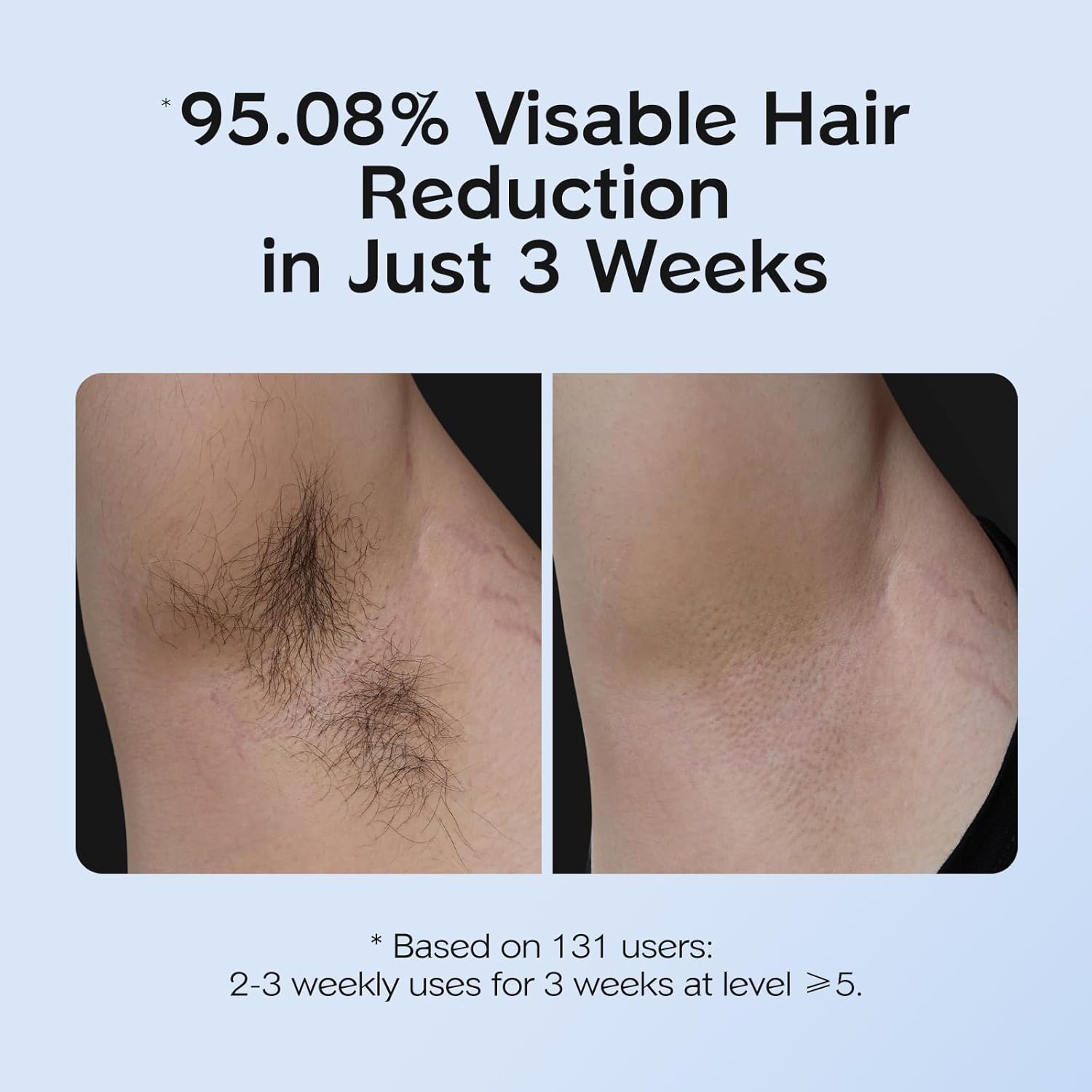 SmoothSkin Ice Hair Remover